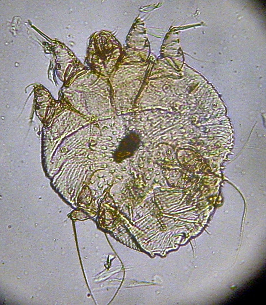 I’m featured in news update on UK scabies outbreak. Make no mistake— scabies infections are common, contagious, and require appropriate treatment. And have long been here in the US. Pic of scabies mite. #dermtwitter #scabies <a href="/OSUWexMed/">The Ohio State University Wexner Medical Center</a> <a href="/FoxNews/">Fox News</a>