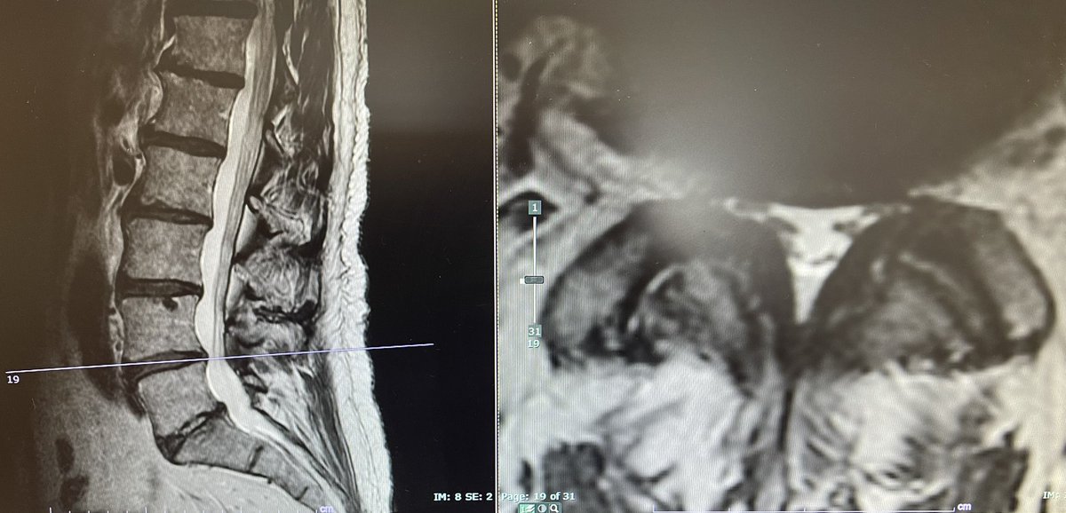 darthglader's tweet photo. More #MSKIR in a man with classic neurogenic claudicarion symptoms. #MRI reveals thickened ligamentum flavum at L4-5 causing central canal stenosis. 

#MILD from @vertosmedical under fluoro. 

🧵… https://t.co/PtAizP3lb1