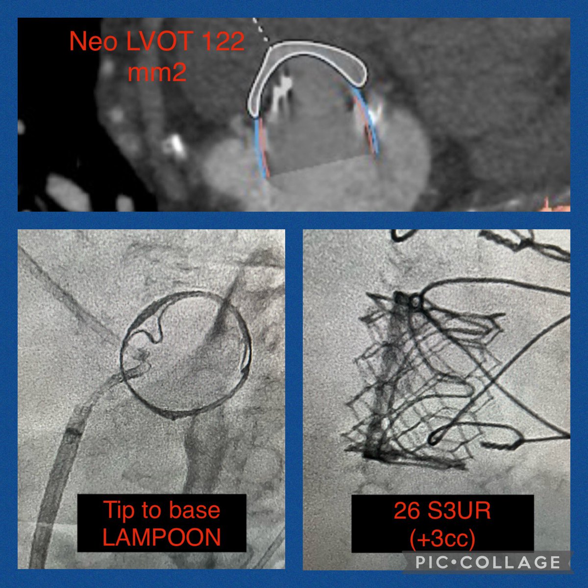 Vigyan Bang (@vigyanbang) on Twitter photo Octogenarian with bioprosthetic valve failure 2/2 calcific mitral stenosis, MG 21 mmHg.
We did our first case of tip to base LAMPOON with ViV TMVR <a href="/FreemanCares4U/">Freeman Health System</a>. Proctored by my good friend <a href="/TsuyoshiKaneko1/">Tsuyoshi Kaneko</a>.
#CardioTwitter Octogenarian with bioprosthetic valve failure 2/2 calcific mitral stenosis, MG 21 mmHg.
We did our first case of tip to base LAMPOON with ViV TMVR <a href="/FreemanCares4U/">Freeman Health System</a>. Proctored by my good friend <a href="/TsuyoshiKaneko1/">Tsuyoshi Kaneko</a>.
#CardioTwitter