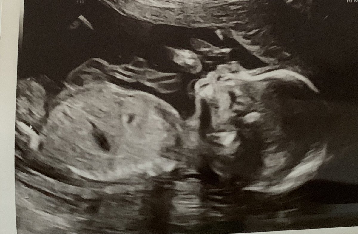 YaAuntieIsHere's tweet image. #ItsABoyπΌπ
#BabyMcCoyπ
We love you so muchπ€ My first grandson π«Άπ½π«‘