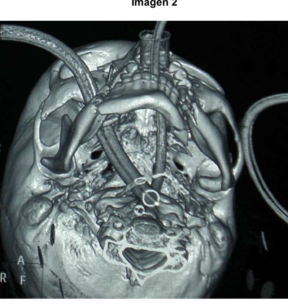 fertanilo's tweet photo. Comentamos las preguntas de #Maxilo del #MIR2024 💀🦷 La primera es una pregunta con imagen, un TAC 3D visto desde abajo con una fractura mandibular bilateral desplazada. https://t.co/gAafLmHd6w
