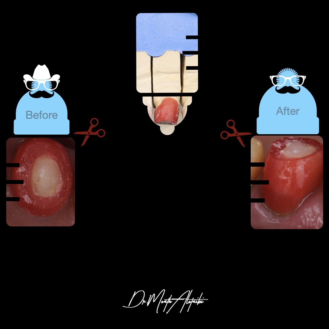 according to desired shade and the thickness of material that Technician needs, Fabrication of [reduction guide] to use on the day of delivery is helpful in some cases for (Dentist-patient)

👇🏼
1- Reduce number of visits
2- Determine the under-prep area
3- Bonding the crown in