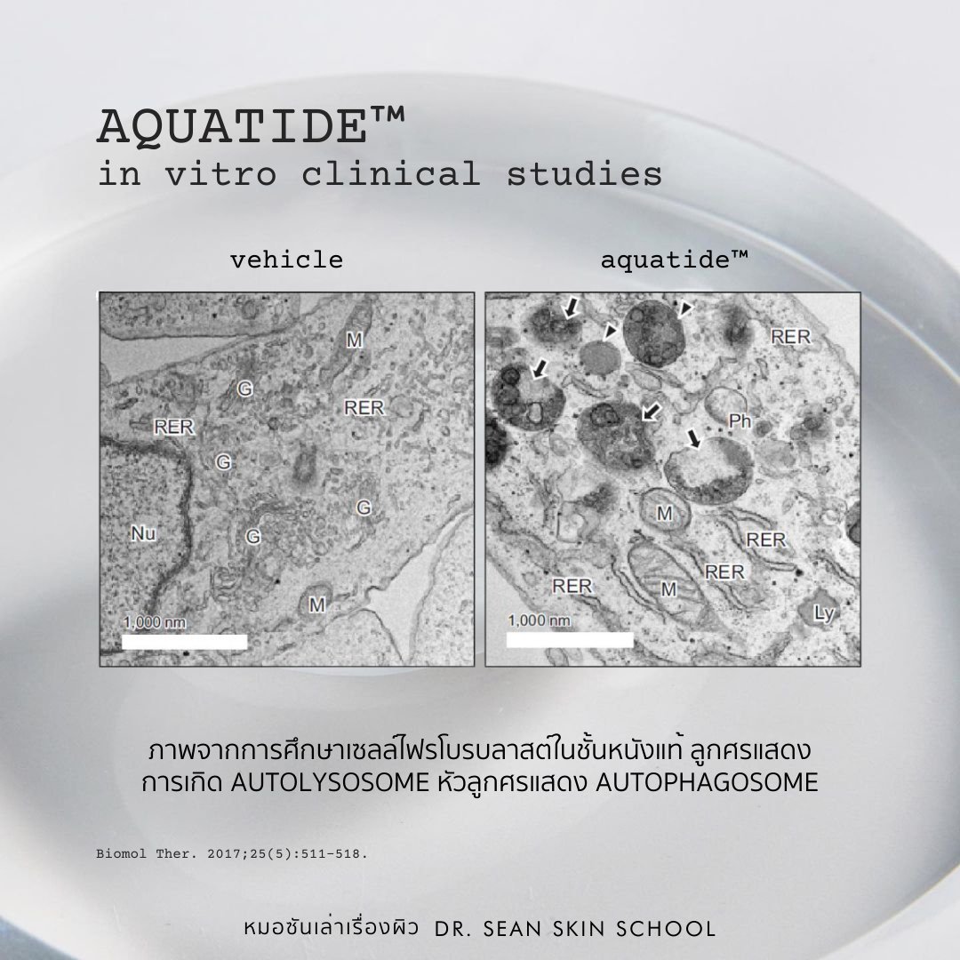 DrSeanSkinSch's tweet photo. ผิวหน้าเริ่มดูป้าแก่ อยากหาสกินแคร์ Anti-aging ดีๆ มาต้านวัย อีกตัวที่ซันว่าปังเลยคือ #LogicallySkin Aquatide Resurface Serum

กลไก Anti-aging ต่างจากตัวอื่น เพราะเค้ามี #Aquatide™ ที่กระตุ้น Autophagy คอนเซ็ปนี้เพิ่งได้รางวัลโนเบลสาขาการแพทย์ปี 2016 นี้เองครับ ตึงจัด https://t.co/QnRcm5X3aO