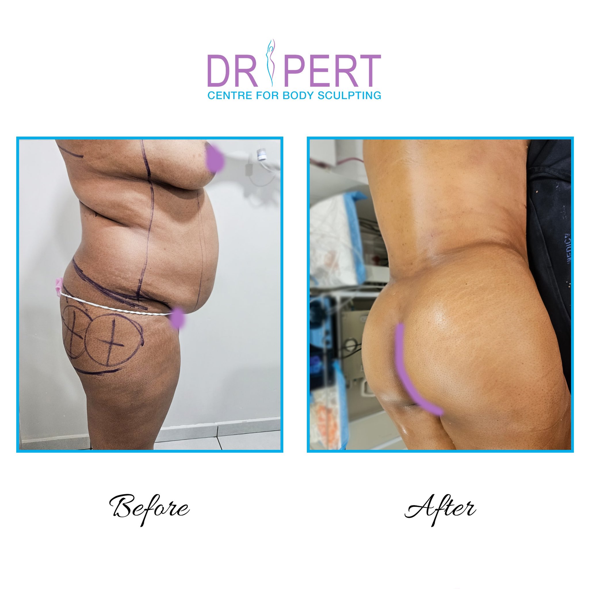 Radiofrequency Body Sculpting  Dr Dheeraj Bhar, Cosmetic & Aesthetic  Surgeon, London