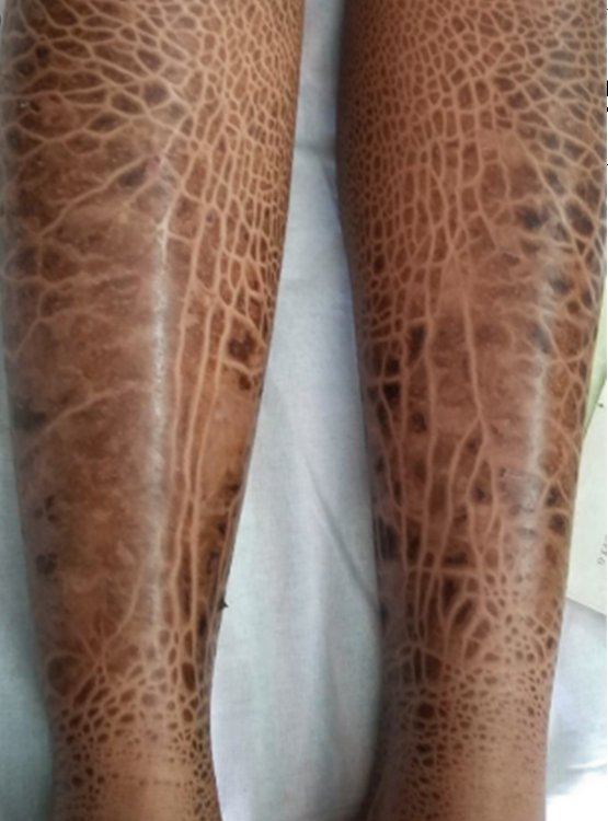 IhabFathiSulima's tweet photo. What is the diagnosis?
Epidemiology?
Rx? https://t.co/5vPa0LieYG