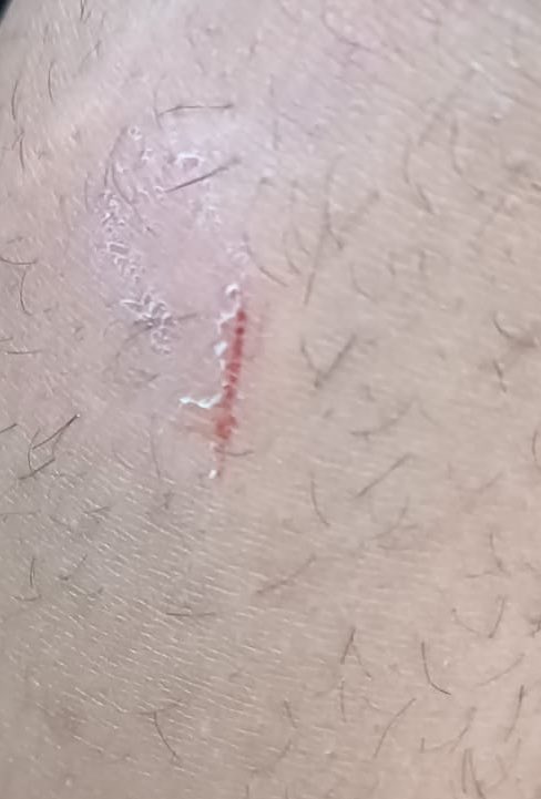 Şu Zum ile Büyütülmüş sinek ısırığına Darp diyorsanız vay ben öleyim 😂
İnsan da utanma olur derki; bunu paylassam gülerler bana. Ama nerde bir de bu çizikle darp raporu alınmış. Tüm feto ve PKK severler bunun la devletin asil evladına saldırıyor.😡
#Kaymakam #imam #BurakAkeller