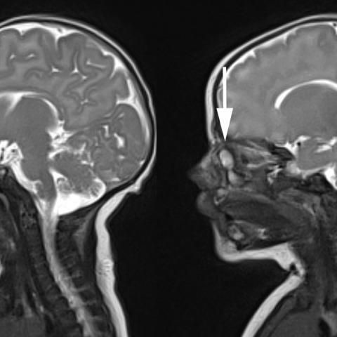 myESR's tweet photo. This weekend's #EuroRad case highlights a 5-week-old child was referred to our Clinic for MRI imaging because of a cystic lesion in the lower nasal cavity on the right (inferior conchae, inferior meatus), clinically described as soft cystic formation, no choanal atresia; https://t.co/ybkTQ6tnaR