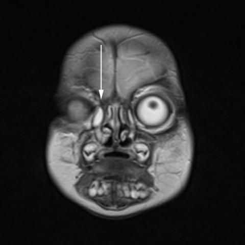 myESR's tweet photo. This weekend's #EuroRad case highlights a 5-week-old child was referred to our Clinic for MRI imaging because of a cystic lesion in the lower nasal cavity on the right (inferior conchae, inferior meatus), clinically described as soft cystic formation, no choanal atresia; https://t.co/ybkTQ6tnaR