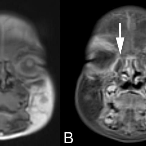 myESR's tweet photo. This weekend's #EuroRad case highlights a 5-week-old child was referred to our Clinic for MRI imaging because of a cystic lesion in the lower nasal cavity on the right (inferior conchae, inferior meatus), clinically described as soft cystic formation, no choanal atresia; https://t.co/ybkTQ6tnaR