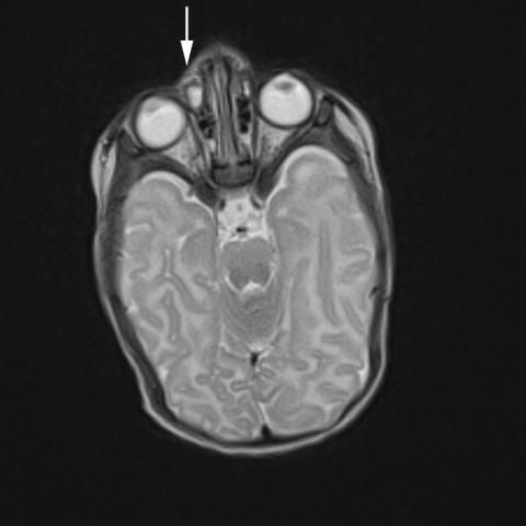 myESR's tweet photo. This weekend's #EuroRad case highlights a 5-week-old child was referred to our Clinic for MRI imaging because of a cystic lesion in the lower nasal cavity on the right (inferior conchae, inferior meatus), clinically described as soft cystic formation, no choanal atresia; https://t.co/ybkTQ6tnaR