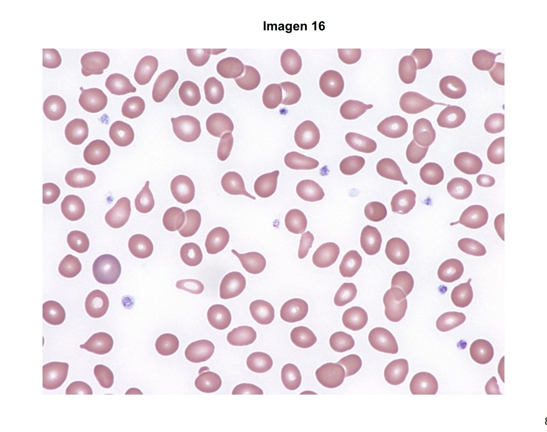 salvadorpayan's tweet image. 🔴Preguntas relacionadas con la #Eritropatología en #MIR24 👇🏾🧵

16: #Dacriocitos, esos hematíes en forma de lágrima.