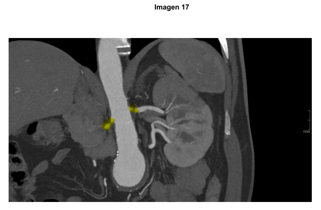 justtmar's tweet photo. Preg 17, imagen (muy fan). Pura técnica test, pero el angioTC ya muestra un riñón derecho prácticamente anulado con clara estenosis (monorreno funcional, exacto), lo que aumenta la susceptibilidad a esta situación. Mantenía el FG gracias al SRAA.
¿✅?Marcaría la opción 3. https://t.co/xfrN4AiPLT