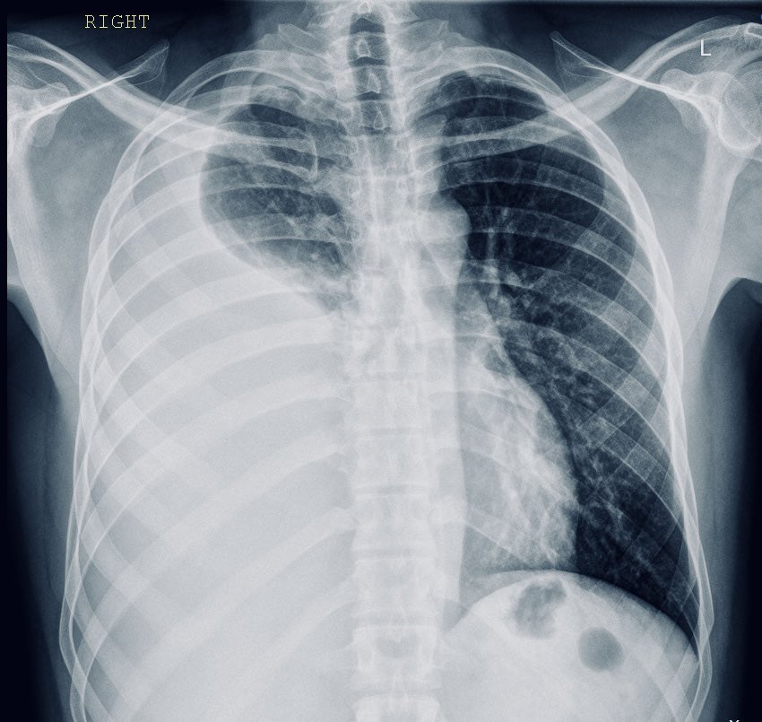 Right-sided chest pain with breathing difficulty

Diagnosis?