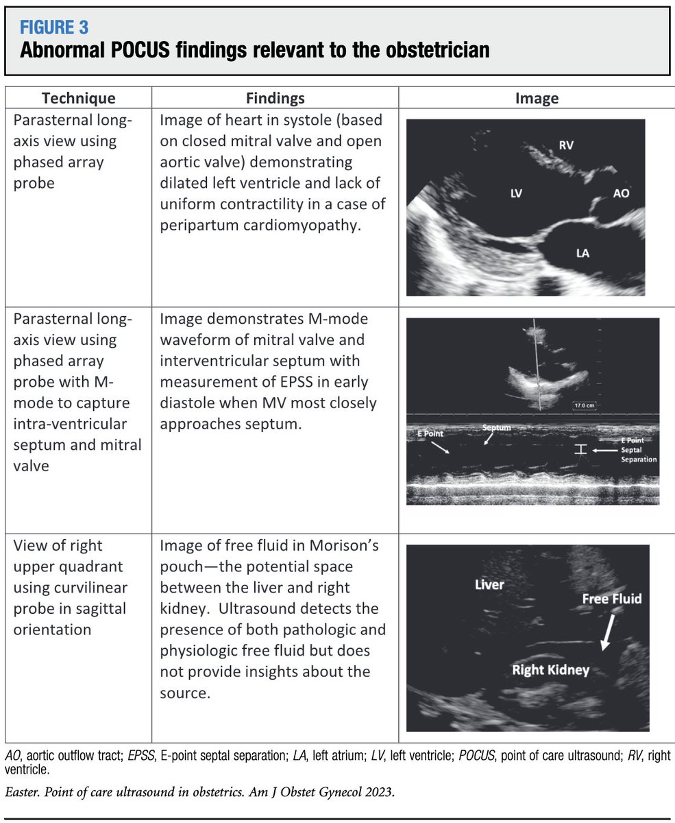 AJOG Expert Review:  Point of care maternal ultrasound in obstetrics ow.ly/OyJy50Oj4BX