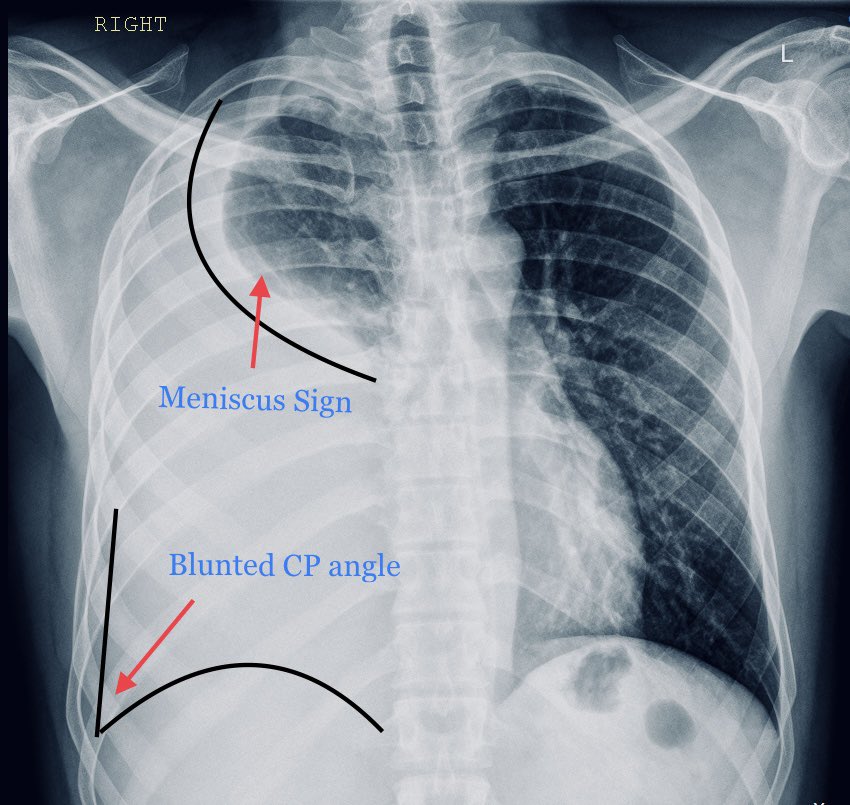 <a href="/docxusofficial/">DocXus</a> Right-sided Pleural Effusion

➔ Blunted right costophrenic angle 

➔ Meniscus sign (concave line) at right lung base ➔ indicates fluid accumulation

➔ Increased density in right lower lung fields ➔ suggests right-sided pleural effusion