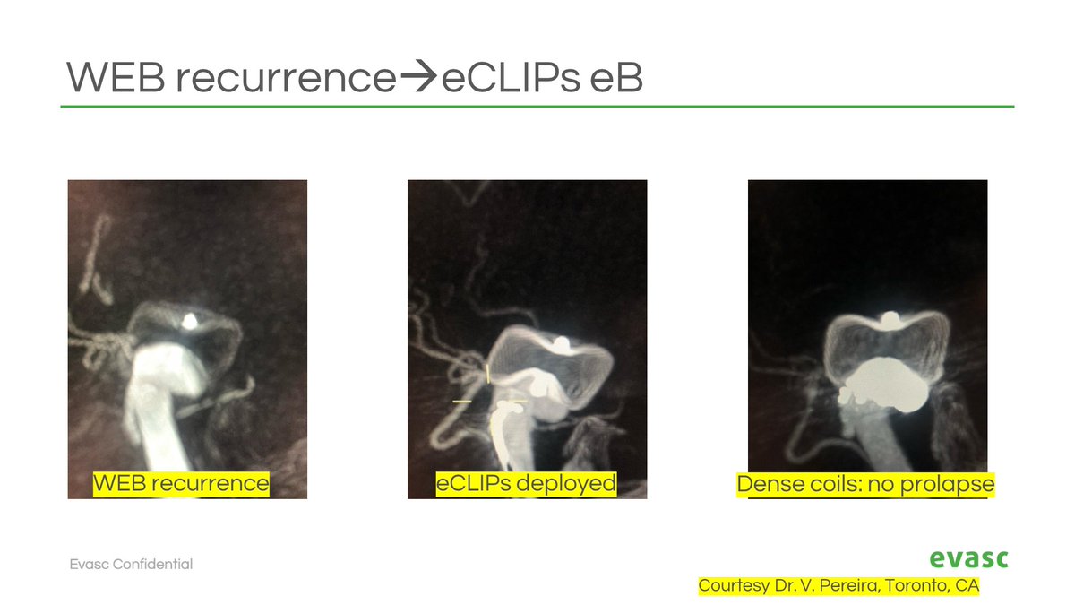 Recurrent aneurysm after intrasaccular treatment? No problem: eCLIPs is the 'closer.'