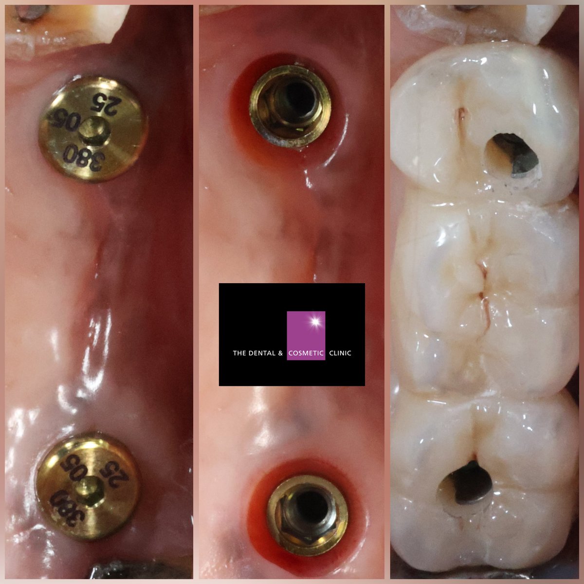 DentandCosmetic's tweet image. Internal sinus lift case to replace 3 failed teeth in the upper left quadrant with @swedenmartina Prama implants supporting a bridge made by the super skilled @194dental_lab 
#sinuslift #boneaugmentation #sinusbonegrafting