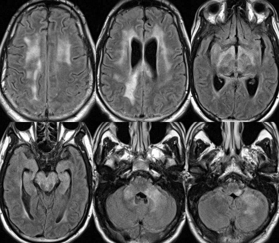 daniel_gewolb's tweet photo. What is the most likely diagnosis in this 25 y/o M presenting w/ subacute encephalopathy?

PMH: Ankylosing spondylitis w/ chronic immunosuppression though w/ recent discontinuation of their monoclonal Ab therapy

More images in 🧵
#neurology #neurosurgery #MedEd #radres #medicine https://t.co/hf5qWaxDqR