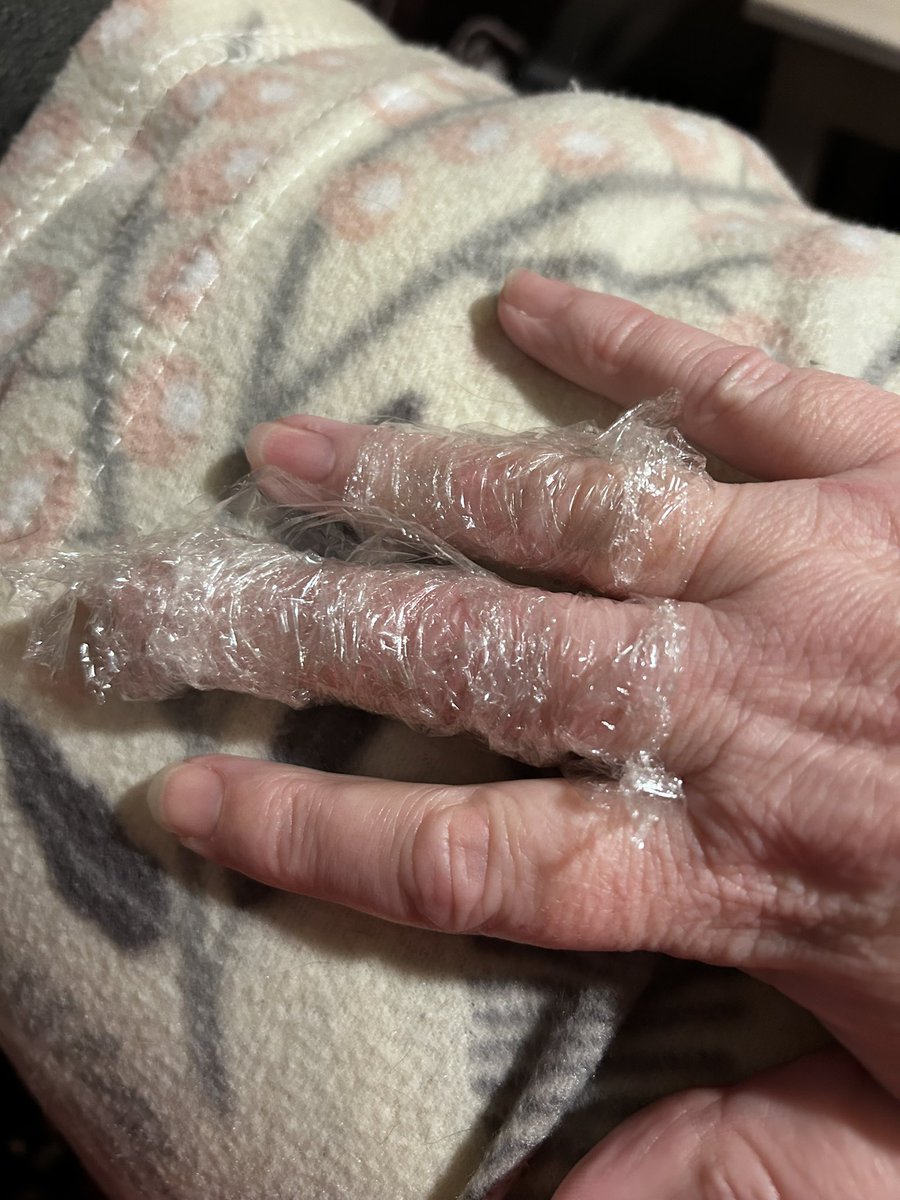 Hippychick_66's tweet photo. @HeinzUK This is the result of heating a tin of your chicken and leek soup for 2 mins in the microwave as per instructions. As spoon went in to stir it exploded, showering me in hot liquid and burning 2 fingers!! https://t.co/6zVnkcSG95