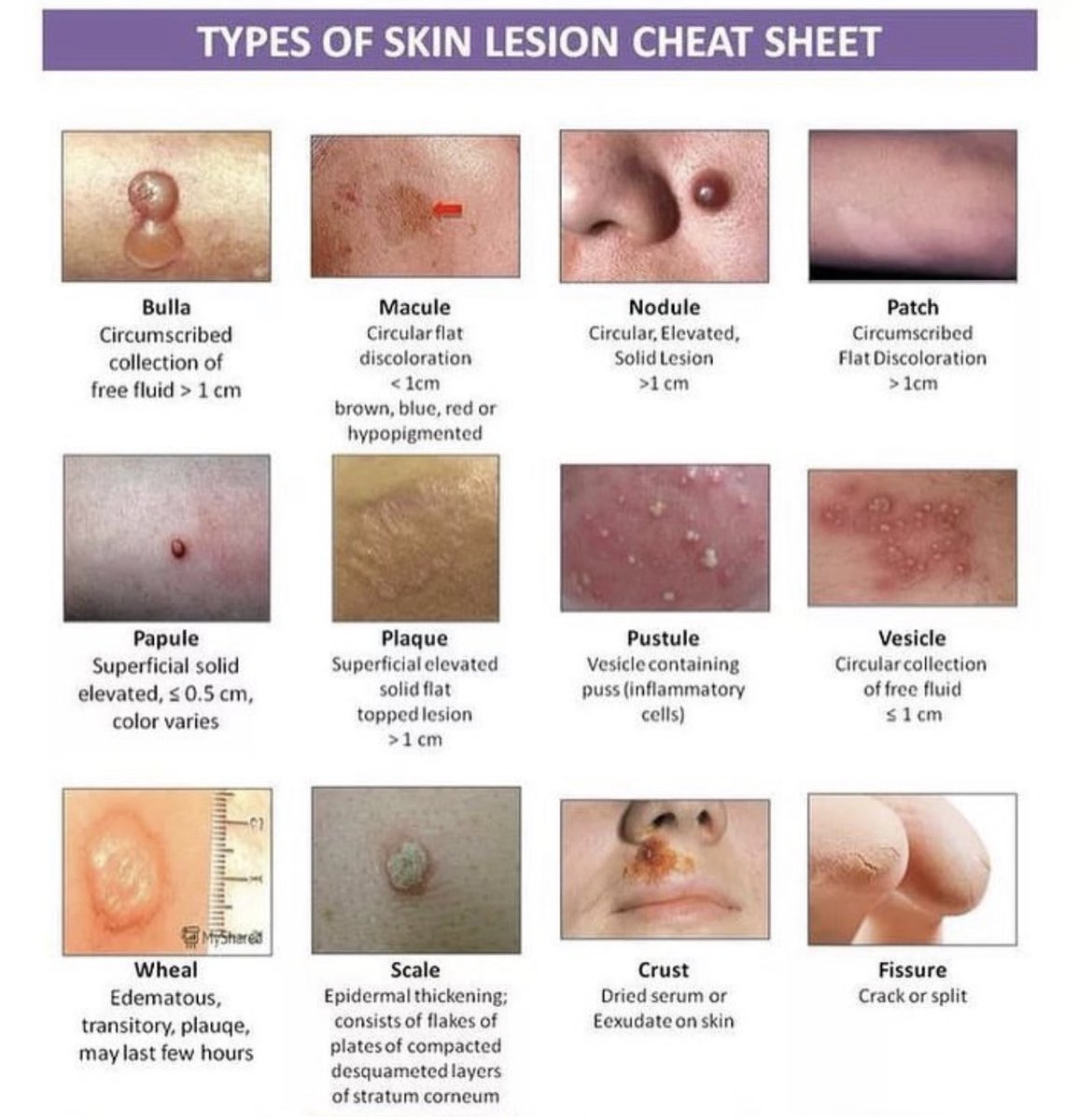 TYPES OF SKIN LESION CHEAT SHEET

#mahri_game