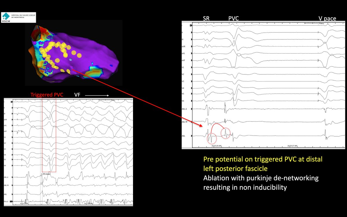 VF hunting with @CerantolaMaxime and super fellow @humbertobmotta Repeated VF triggered by fascicle PVCs in isch cardiomyopathy pt. Nice reversal of signals at distal post fascicle. De-networking of purkinje--> non inducible #AblateVT