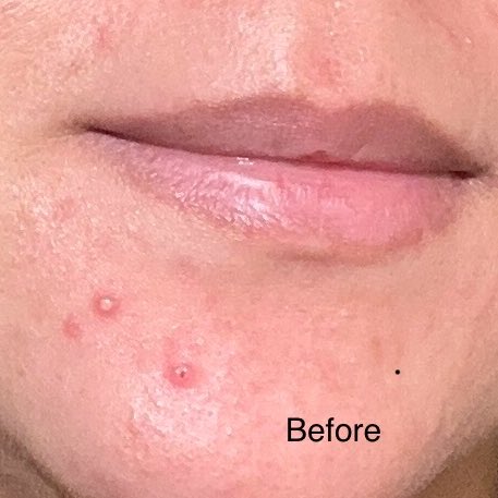 angelictorns's tweet image. SOBAT QUARTER LIFE CRISIS, SAATNYA PAKE SERUM INI 🥹☝🏻

Udah bosen pake retinol? Butuh upgrade? Kata aku masukin serum ini ke list serum yang wajib dicoba tahun 2024!

— #racuninskincare