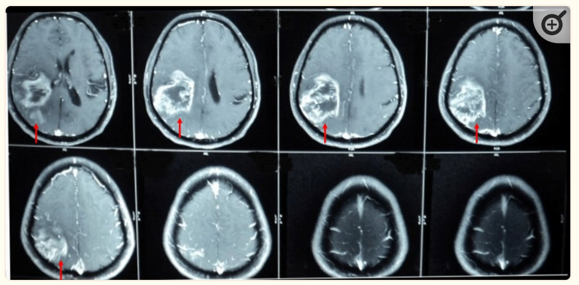 Always include a radiologist when using images in an article! These images come from a case-report on vascular dementia. The lesions was reported to be "an ischemic stroke with hemorrhagic transformation". No radiologist on the author list. #radiology #NeuroRad #RadED #FOAMrad