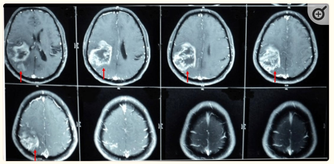 Always include a radiologist when using images in an article! These images come from a case-report on vascular dementia. The lesions was reported to be 'an ischemic stroke with hemorrhagic transformation'. No radiologist on the author list. #radiology #NeuroRad #RadED #FOAMrad