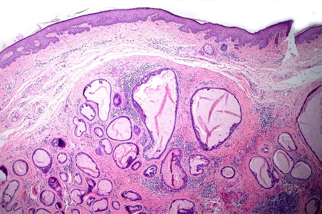 GeronimoJrLapac's tweet photo. Ear pinna lesion. Dx?
#pathplus #pathology #pathologist #dermpath https://t.co/OLWnkVENgB