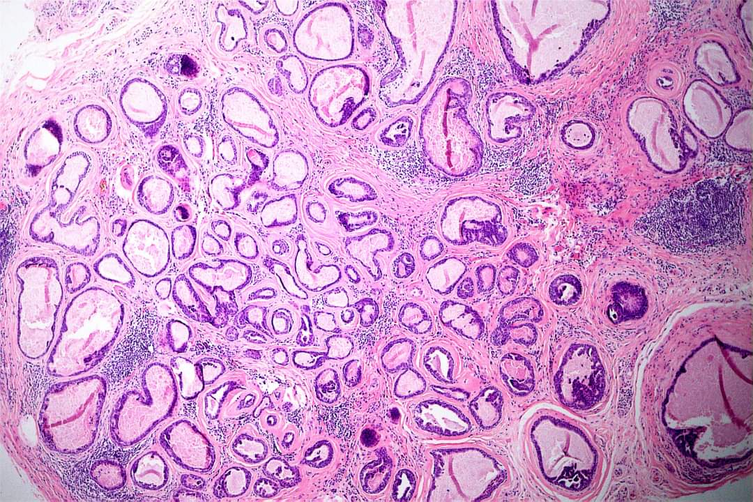 GeronimoJrLapac's tweet photo. Ear pinna lesion. Dx?
#pathplus #pathology #pathologist #dermpath https://t.co/OLWnkVENgB