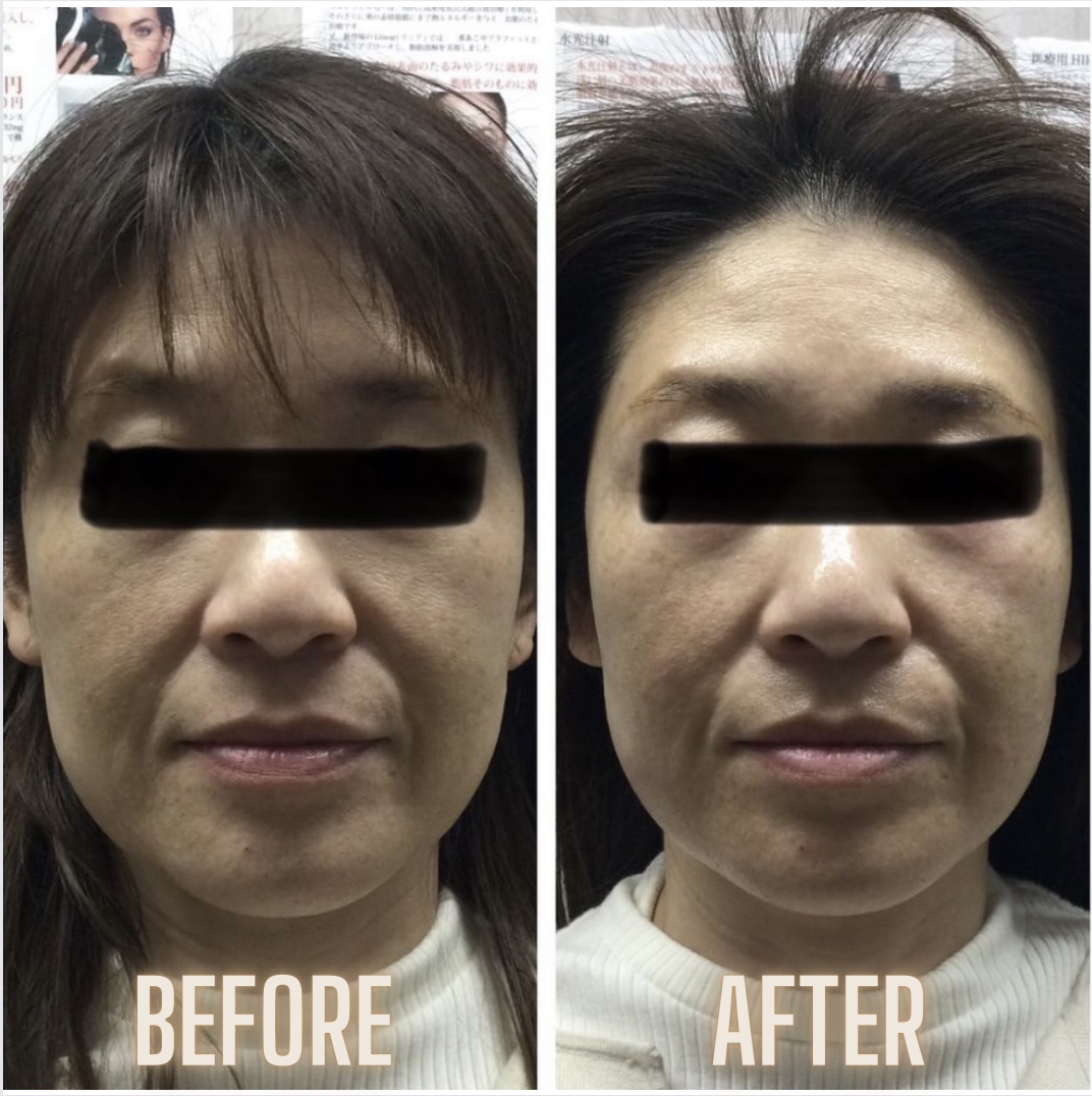 ClairClinic's tweet photo. 🎀気になるたるみ、しわにはハイフがオススメ🎀
・
🌷40代後半　女性
・
🌷頬+顎下+目元の施術　400ショット
・
🌷お値段 66,000円
・
ハイフはダウンタイムのないリフトアップの施術ですので、ぜひ一度お試し頂きたい施術です🥰❤️‍🔥❤️‍🔥
☎0800-800-9766
＃ハイフ　＃小顔になりたい　＃たるみ改善 https://t.co/hiHmkubuUH