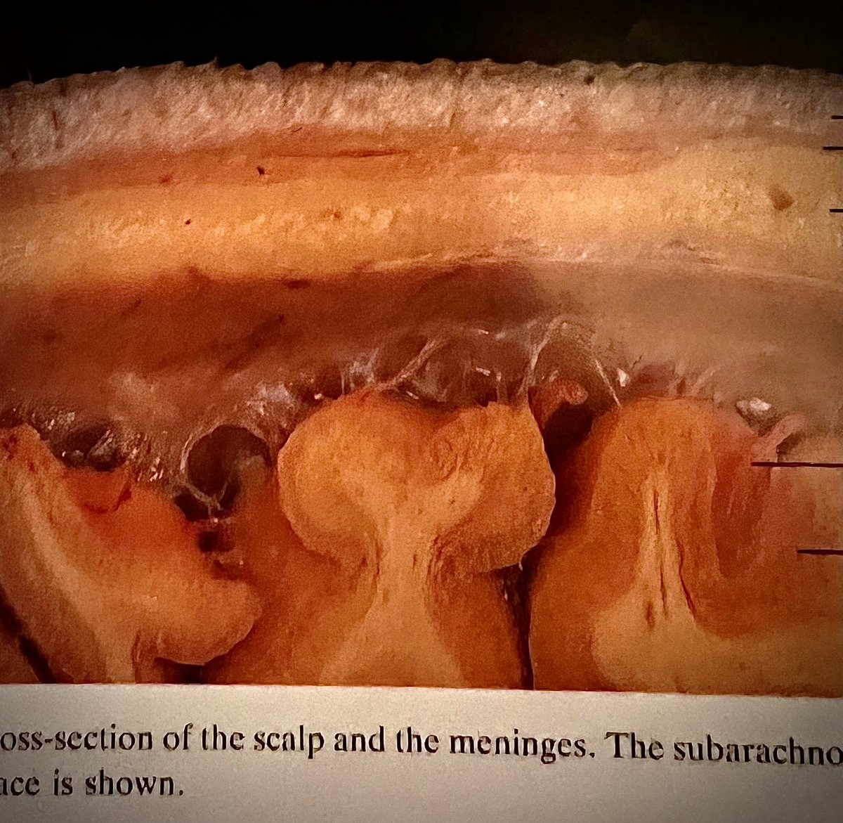 Osasuna Liposomal Astaxanthin 24 mg caps seem to restore a gel layer missing above the brain and just under the skull. An algae molecule that is an anti-inflammatory -reported here as ‘soothing’ - reduces brain fog per patient report in a 3-year long covid case.