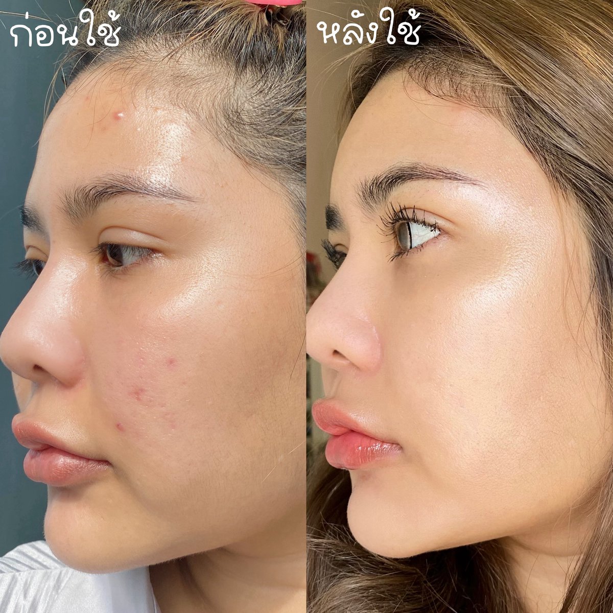 hafonlyone's tweet photo. เข้าไทยแล้วจ้า cerave retinol serum ตัวใหม่ นี่ลองมาพักใหญ่ๆแล้ว จะบอกว่าชีเริ่ดนะ อย่างแรกที่เห็นชัดๆเลยคือรอยสิวลดลงเยอะมาก จากดำๆคือจางเลย ยิ่งพวกรอยใหม่ๆคือแทบไม่มองเห็นแล้ว ผิวเนียนขึ้น สมูทขึ้น สีผิวสม่ำเสมอเท่ากัน ชอบสุดตรงไม่แสบไม่แดงไม่แห้งตึง ทำดี! ทำถ��ง! 1000/10 ไม่หัก https://t.co/zl51V5HRnb