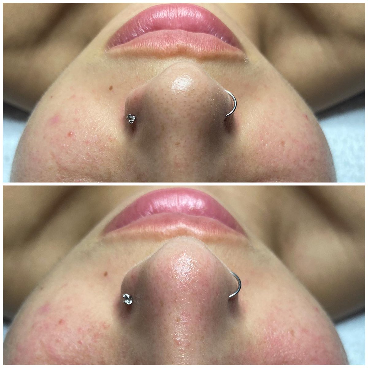 Thank you @skinlyssesthetics for sharing the power of Theraderm 🌟 

theradermclinical natural enzyme peel + extractions 🫶🏼

——
#facialmassage #facial #beauty #skincare #skin #yqg #windsor #esthetician #like #follow #aesthetics #beforeandafter ( #📷 @skinlyssesthetics )