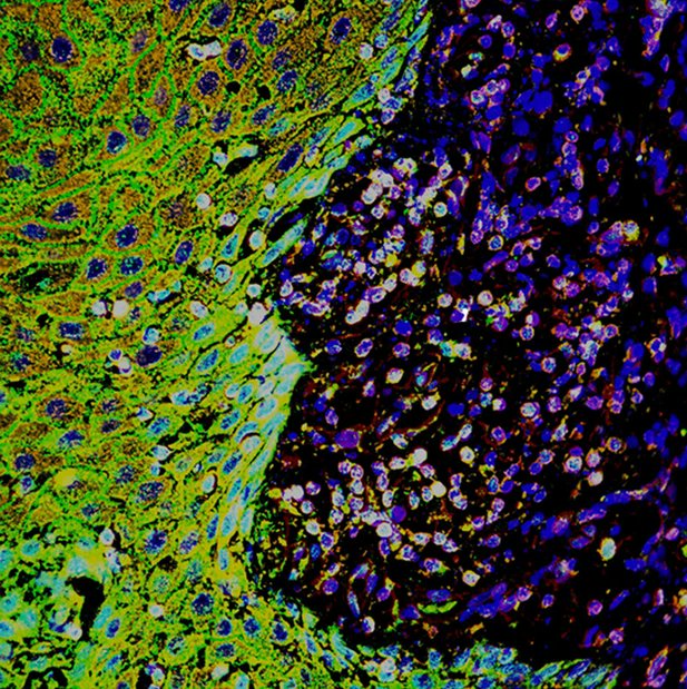The National Centre for the 3Rs (@nc3rs) on Twitter photo Great to see methods first developed by <a href="/DrABiddle/">Adrian Biddle</a> in his Fellowship continue to be used with new technologies to replace animals in cancer research. This latest paper uses machine learning to analyse human tumour samples and predict risk of metastasis: elifesciences.org/articles/90298 Great to see methods first developed by <a href="/DrABiddle/">Adrian Biddle</a> in his Fellowship continue to be used with new technologies to replace animals in cancer research. This latest paper uses machine learning to analyse human tumour samples and predict risk of metastasis: elifesciences.org/articles/90298