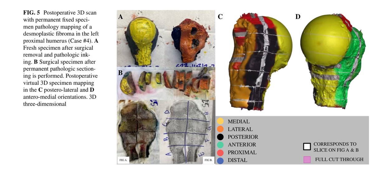 link.springer.com/article/10.124…

Check out our recent collaborative work @AnnSurgOncol on 3D scanning resected specimens in Musculoskeletal Oncology! 
#orthopaediconcology #musculoskeletaloncology #orthoonc #orthotumor #orthotwitter #sarcoma @TopfHNS