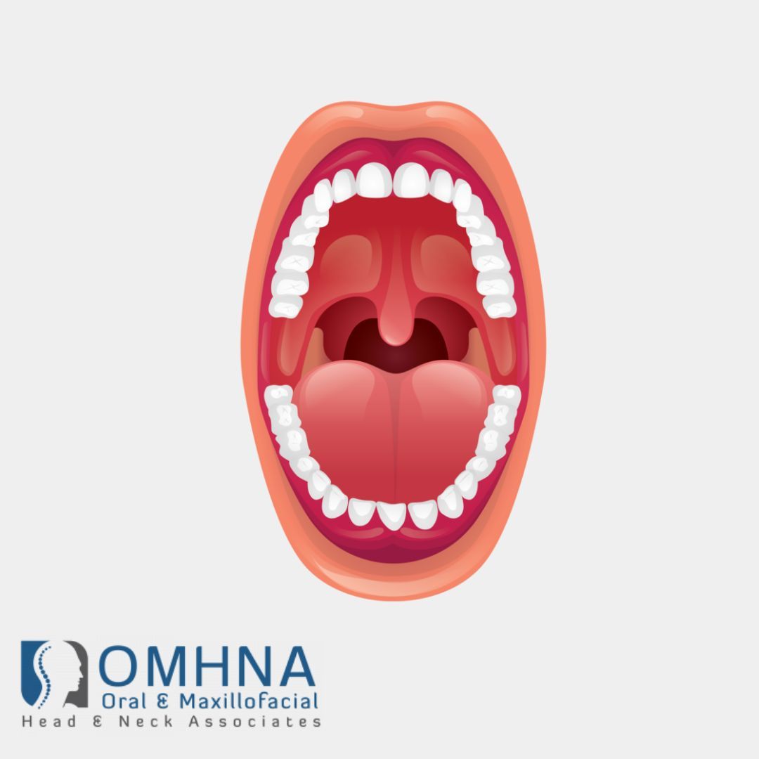 Oropharyngeal cancer, which affects areas in the throat such as the tonsils and base of the tongue, has seen promising advancements in treatment and curability, with early detection and modern treatment methods.

#OropharyngealCancer #CancerSurvival #EarlyDetection #OMHNAcare