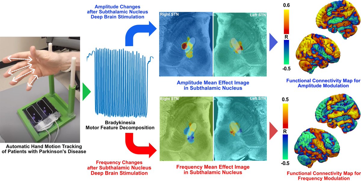 braincomms's tweet image. Kim et al. report on subthalamic nucleus #deepbrainstimulation–induced volumes of tissue activation associated with individual components of #ParkinsonsDisease bradykinesia. @minjaekim716 @kmillsy @HopkinsMedicine @HopkinsNsurg shorturl.at/bwDOX