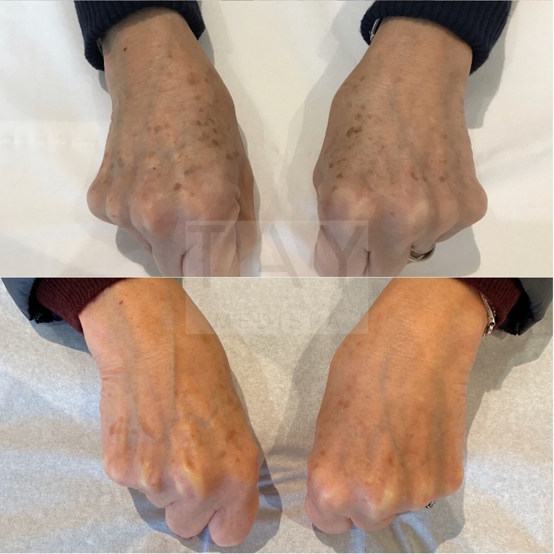 TayMediSpa's tweet photo. Before &amp; After a Sunspot Reduction treatment with Michelle
⁠
Treatments are £140 each, visit our website to find out more and to book your free consultation: https://t.co/MLJyZF7fwx⁠
⁠
#sunspots #skinrejuvenation #skinclinic #medispa #perth #perthshire #perthuk https://t.co/MgGIIhUKba