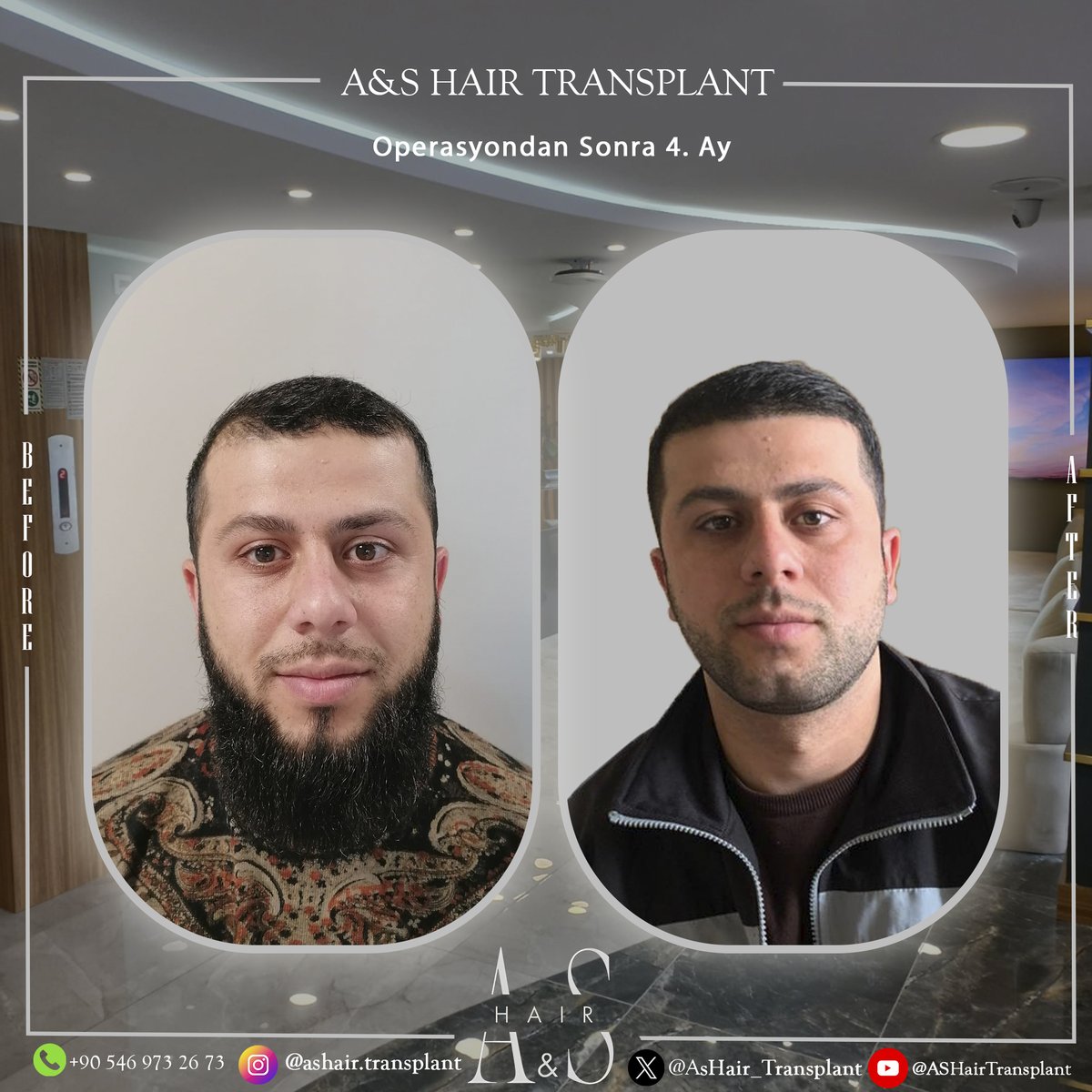 A&S Hair Transplant (@AsHair_Istanbul) / Posts / X