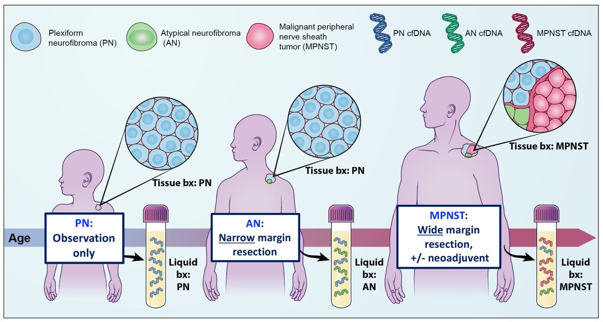 4/ But identifying atypical neurofibroma (AN) is clinically relevant. PN are generally observed while MPSNT require wide-margin, morbid resections if operable. Pre-malignant AN are the ideal time to intercept/intervene.