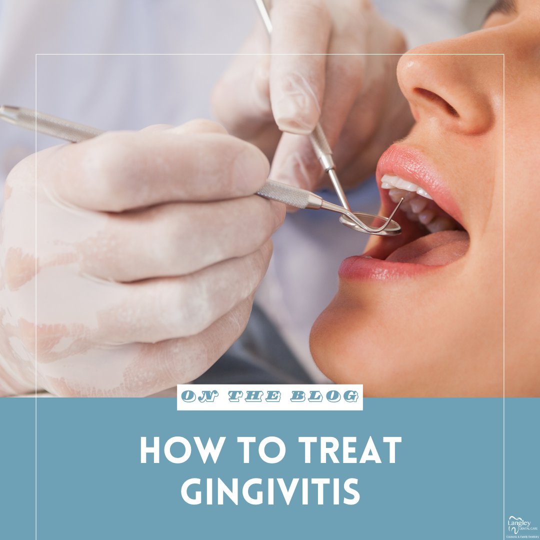 Gingivitis refers to a condition when the gums become irritated and inflamed. Learn how to treat it: bit.ly/3TNhBhn