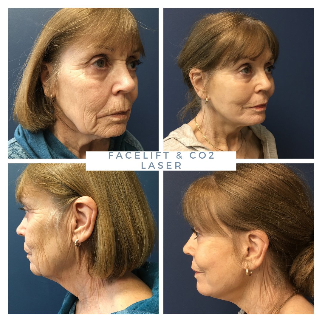 MarkMcClungMD's tweet image. Such a beautiful transformation! We did a facelift with a CO2 laser resurfacing of her face and neck. Total facial rejuvenation!
#facelift #facialrejuvenation #co2laser