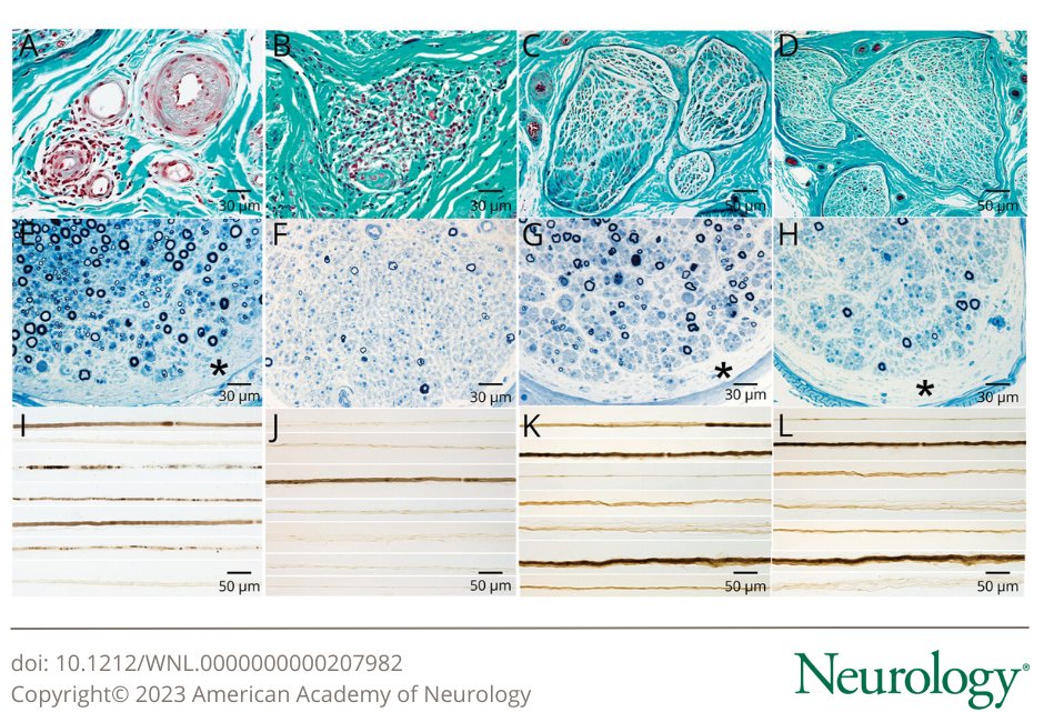 GreenJournal's tweet photo. According to this study, axonal loss, subperineurial edema, and an absence of prominent inflammation are the most common findings in nerve biopsies of patients with #paraneoplastic antibodies strongly associated with cancer. https://t.co/Odkm3K0u1d

#NeuroTwitter https://t.co/3nI5PZqE7b