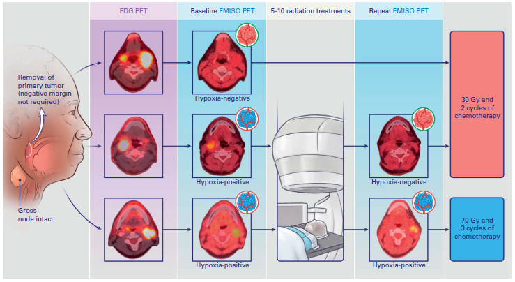 Memorial Sloan Kettering Radiation Oncology (@msk_radonc) on Twitter photo ☢️<a href="/JCO_ASCO/">Journal of Clinical Oncology</a>: Of 152 analysable pts, 128 had nonhypoxic tumors & received 30Gy w chemo instead of SOC 70Gy.
Hypoxia driven de-escalation to curative-intent CRT for HPV+ #hncsm oropharyngeal cancer found preserved efficacy & substantially reduced toxicity.
ascopubs.org/doi/full/10.12… ☢️<a href="/JCO_ASCO/">Journal of Clinical Oncology</a>: Of 152 analysable pts, 128 had nonhypoxic tumors & received 30Gy w chemo instead of SOC 70Gy.
Hypoxia driven de-escalation to curative-intent CRT for HPV+ #hncsm oropharyngeal cancer found preserved efficacy & substantially reduced toxicity.
ascopubs.org/doi/full/10.12…