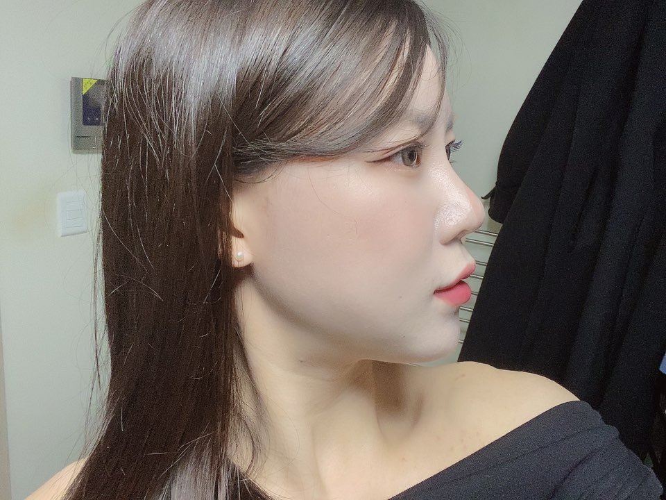 anan000807's tweet photo. 輪郭3点　DTちょーと1ヶ月✨✨✨

2週間後に日本から友達来るからそれまでもっと腫れ収まってくれたらいいなぁ。中学校からの友達4ヶ月ぶりくらいに会うから楽しみすぎる🖤　

#輪郭3点　#整形　#韓国整形　#韓国渡航 https://t.co/MyUABONZzw