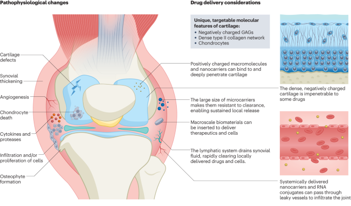 NatRevRheumatol's tweet photo. New content online! Engineering approaches for RNA-based and cell-based osteoarthritis therapies https://t.co/iVzxpXLLbu https://t.co/e4d3DCUWG3