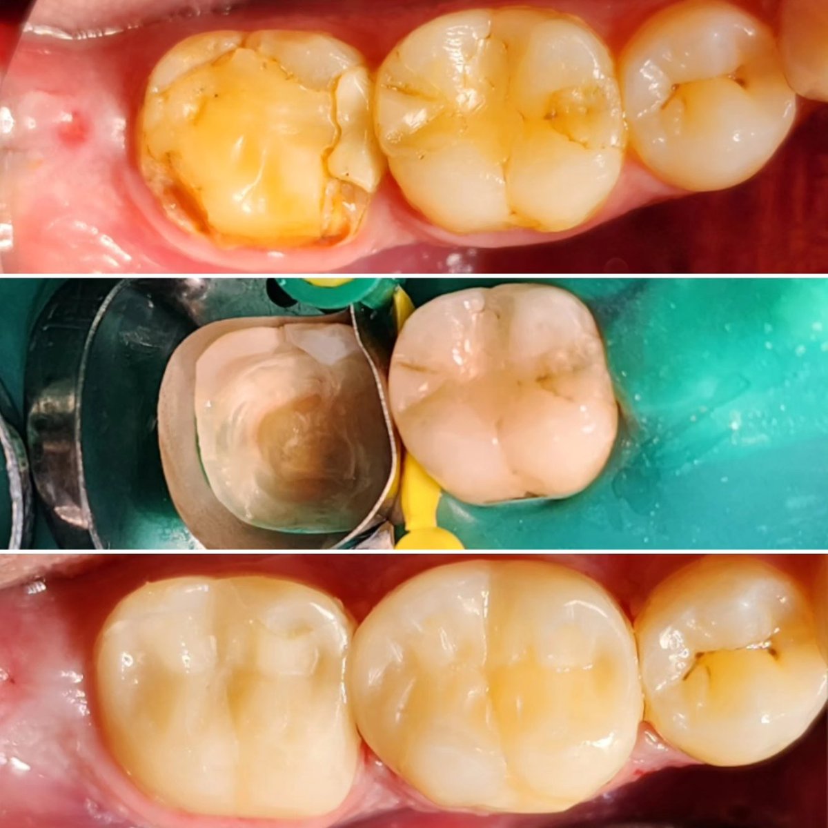 #ksa #riyadh #wael #dentist #dentistry #cosmetic #esthetic #healthy #beauty #art #Biomimetic #holistichealth #justcomposite  #matrix #mimicking #amalgam #onevisit #mock #cosmatic #capping #diastema #compeneer 
#conservative 
#السعودية #الرياض #وائل #حشوات #كمبوزيت