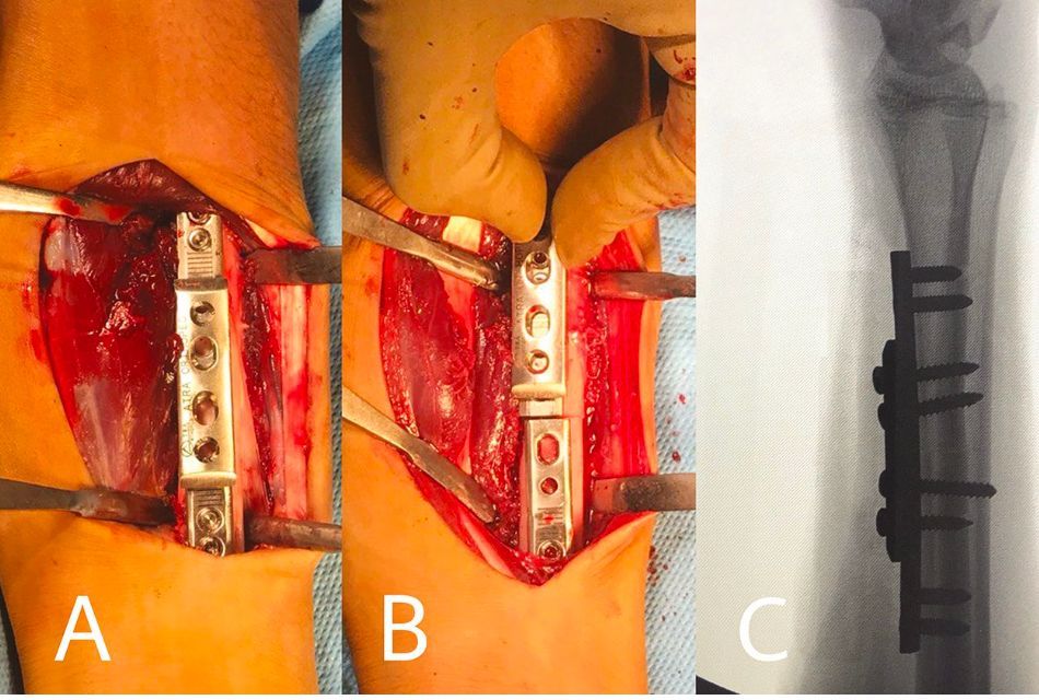 NazarianLab's tweet photo. ✨ @javadshariati innovative Sliding Plate System for radial shortening osteotomy. 🛠️🦴efficiency and safety in #Kienböck disease. Increased accuracy in shortening, compression, and alignment! 🚀 🌐👩‍⚕️ @BIDMC @ortho_BIDMC https://t.co/I3v8VMG6as https://t.co/NWF2LqjST5