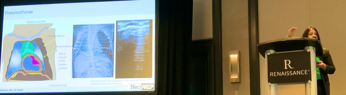 Dr. Shazia Bhombal includes bedside #neoPOCUS tips, teaching respiratory distress in term infants
#NeoPrep2024